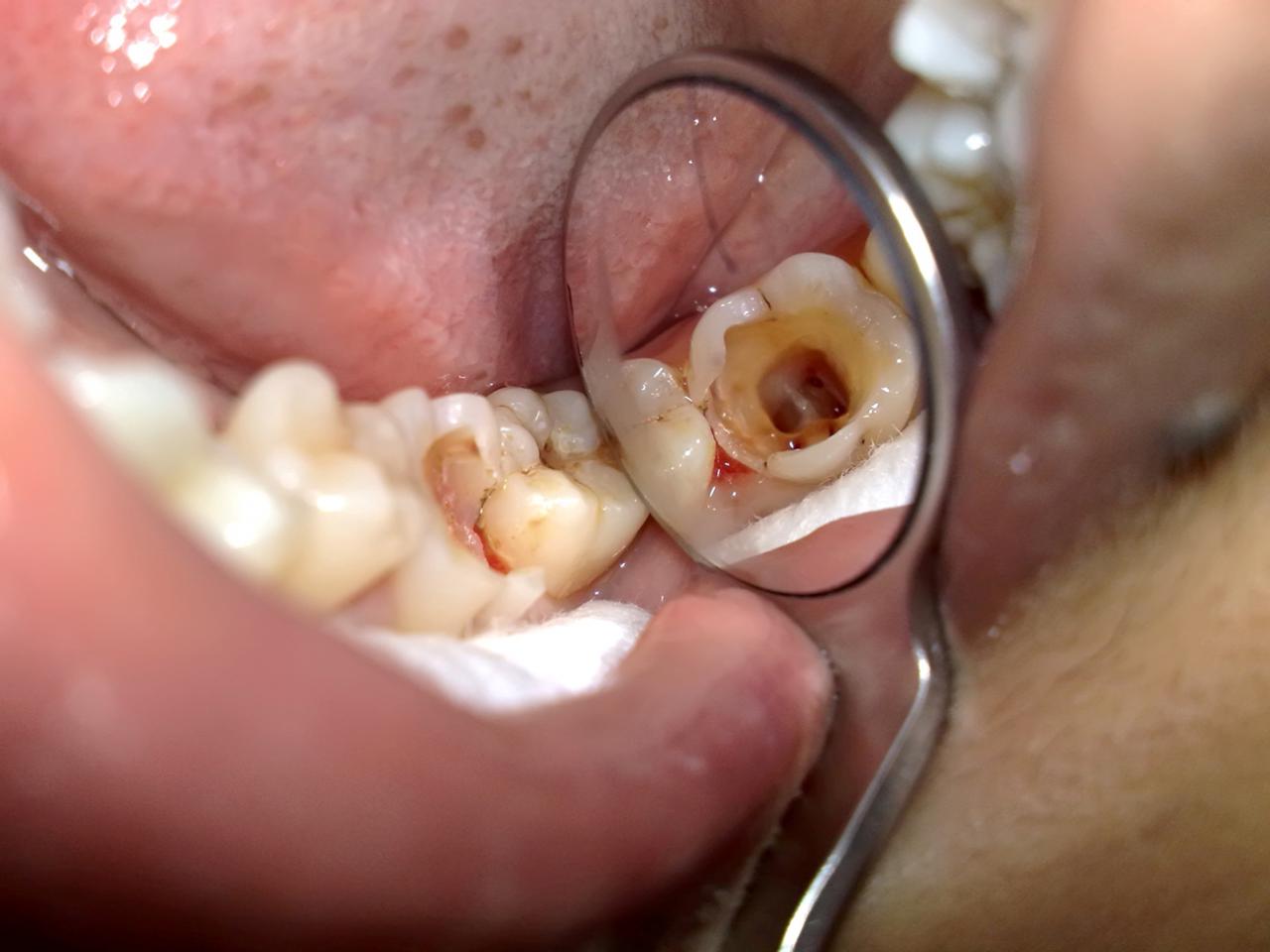 Kết quả hình ảnh cho sâu răng