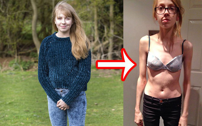 Cô gái trẻ nghiện giảm cân đến nỗi suýt mất mạng vì muốn sở hữu được thân hình siêu mỏng - Ảnh 1.