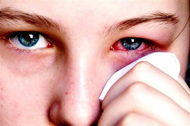Dùng lá trầu không để xông khi đau mắt đỏ: Cẩn thận bệnh nặng càng thêm nặng! - Ảnh 3.