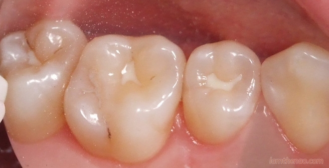 10 thói quen nhỏ gây hại cho răng cần chấm dứt ngay lập tức!
