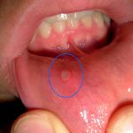 Khỏi lở miệng ở trẻ nhỏ chỉ trong 1 nốt nhạc