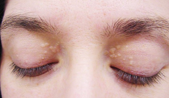 Những u vàng quanh mắt không chỉ làm bạn xấu mà còn cảnh báo nhiều nguy cơ bệnh - làm sao để loại bỏ chúng? - Ảnh 5.