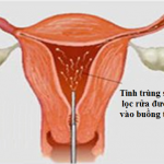 Sau khi làm IUI bị ra máu có làm sao không, có thụ thai được không? - Ảnh 2.